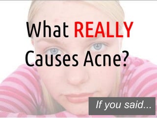 What REALLY
Causes Acne?
       If you said...
 