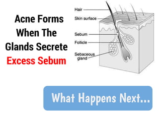 Acne Forms
  When The
Glands Secrete
Excess Sebum


          What Happens Next...
 