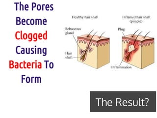 The Pores
 Become
 Clogged
 Causing
Bacteria To
  Form

              The Result?
 