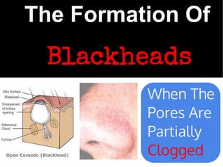 The Formation Of
 Blackheads
          When The
          Pores Are
          Partially
          Clogged
 