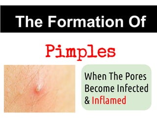 The Formation Of
   Pimples
        When The Pores
        Become Infected
        & Inflamed
 