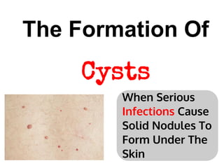 The Formation Of
     Cysts
        When Serious
        Infections Cause
        Solid Nodules To
        Form Under The
        Skin
 