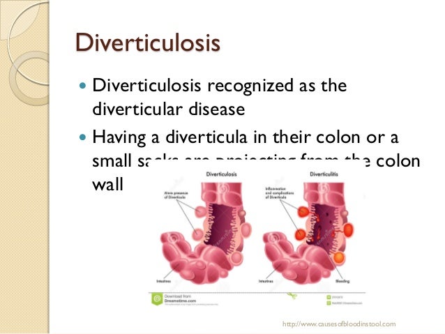 Causes of blood in stool
