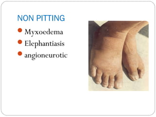Causes of edema | PPT