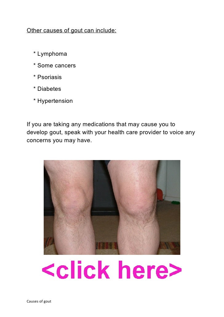 Can Excessive Beer Drinking Cause Gout Can Excessive Beer Drinking Cause Gout