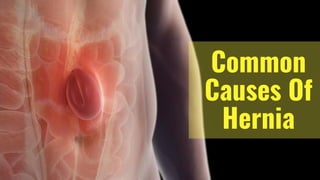 Common
Causes Of
Hernia
 