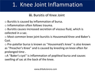 www.drbakularora.com
1. Knee Joint Inflammation
iii. Bursitis of Knee Joint
o Bursitis is caused by inflammation of bursa.
o Inflammation often follows trauma.
o Bursitis causes increased secretion of viscous fluid, which is
collected in a sac.
o Most common knee joint bursitis is Housemaid Knee and Baker's
Cyst.
o Pre-patellar bursa is known as ''Housemaid's knee'' is also known
as ''Preacher's Knee" and is caused by kneeling on knee often for
prolonged time .
oA ''Baker's cyst'' is inflammation of popliteal bursa and causes
swelling of sac at the back of the knee.
 