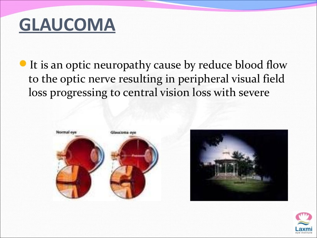 Causes of low vision in adult