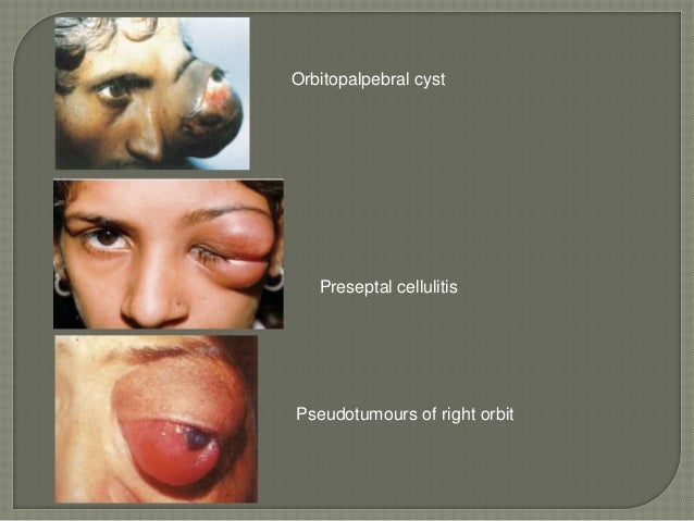 causes of proptosis proptosis