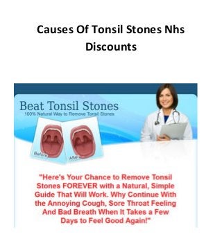 Causes Of Tonsil Stones Nhs
Discounts
 