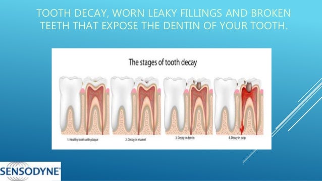 Causes Of Tooth Sensitivity