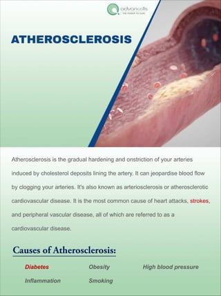 Atherosclerosis is the gradual hardening and onstriction of your arteries
induced by cholesterol deposits lining the artery. It can jeopardise blood flow
by clogging your arteries. It's also known as arteriosclerosis or atherosclerotic
cardiovascular disease. It is the most common cause of heart attacks, strokes,
and peripheral vascular disease, all of which are referred to as a
cardiovascular disease.
Causes of Atherosclerosis:
Diabetes Obesity High blood pressure
Inflammation Smoking
 
