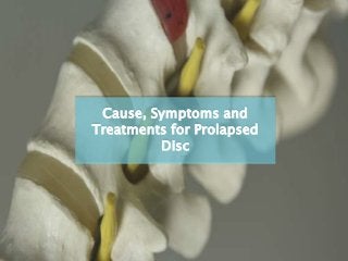 Cause, Symptoms and
Treatments for Prolapsed
Disc
 