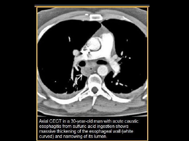 Caustic esophagitis