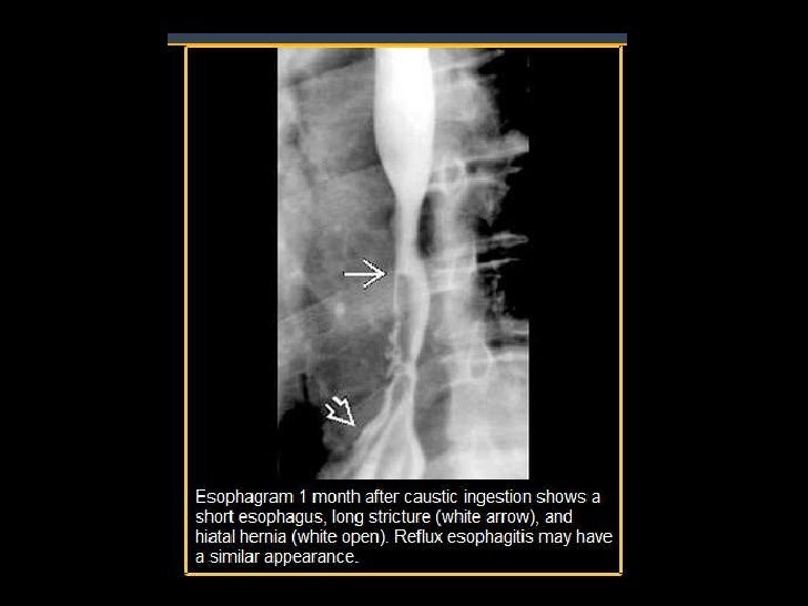 Caustic esophagitis