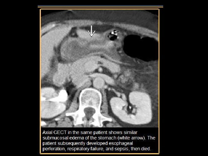 Caustic esophagitis