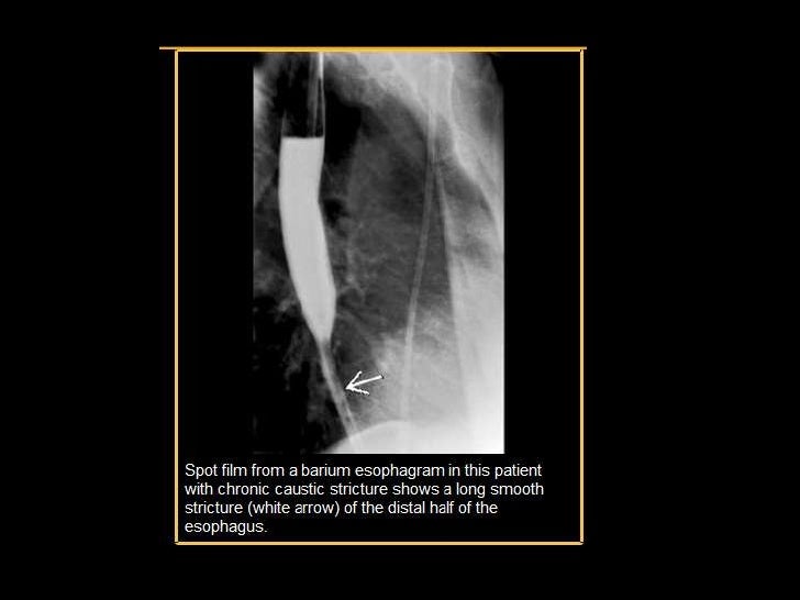 Caustic esophagitis