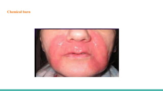 Chemical burn
 