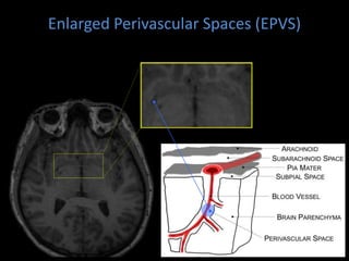 The glymphatic system in sleep and neurodegenerative diseases | PPTX