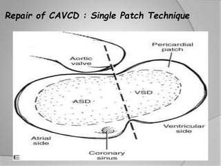 Avsd Wave avsd | PPTX