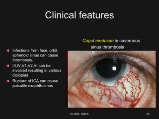Clinical features
Infections from face, orbit,
sphenoid sinus can cause
thrombosis.
III,IV,V1,V2,VI can be
involved resulting in various
diplopias
Rupture of ICA can cause
pulsatile exophthalmos
Caput medusae in cavernous
sinus thrombosis
Dr.GPK, OMFS 22
 