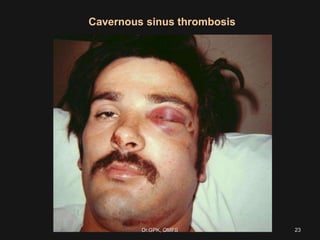 Cavernous sinus thrombosis
23Dr.GPK, OMFS
 