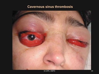 Cavernous sinus thrombosis
24Dr.GPK, OMFS
 