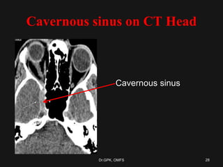 Cavernous sinus on CT Head
Cavernous sinus
28Dr.GPK, OMFS
 
