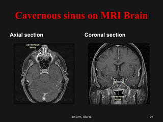 Cavernous sinus on MRI Brain
Axial section Coronal section
29Dr.GPK, OMFS
 