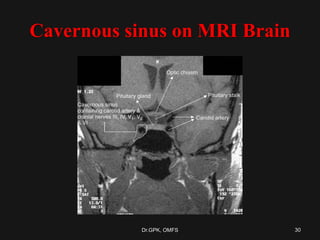 Cavernous sinus on MRI Brain
30Dr.GPK, OMFS
 