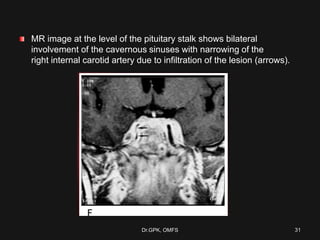 MR image at the level of the pituitary stalk shows bilateral
involvement of the cavernous sinuses with narrowing of the
right internal carotid artery due to infiltration of the lesion (arrows).
Dr.GPK, OMFS 31
 