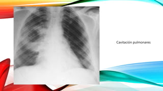 ABSCESO PULMONAR Cavitación pulmonares
Foto de Yale Rosen from USA / CC BY-SA 2.0
 