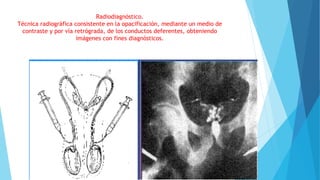 Radiodiagnóstico. 
Técnica radiográfica consistente en la opacificación, mediante un medio de 
contraste y por vía retrógrada, de los conductos deferentes, obteniendo 
imágenes con fines diagnósticos. 
 