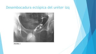 Desembocadura ectópica del uréter izq 
 