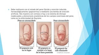  Debe realizarse con el estado del pene flácido y erección inducida 
farmacológicamente (papaverina) o mediante una bomba de erección 
artificial. Nos muestra con certeza si hay o no sistema de drenaje 
inadecuados y alteraciones anatómicas de los cuerpos cavernosos del pene, 
como en la enfermedad de Peyronie. 
 