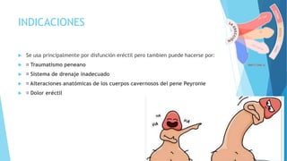 INDICACIONES 
 Se usa principalmente por disfunción eréctil pero tambien puede hacerse por: 
 Traumatismo peneano 
 Sistema de drenaje inadecuado 
 Alteraciones anatómicas de los cuerpos cavernosos del pene Peyronie 
 Dolor eréctil 
 