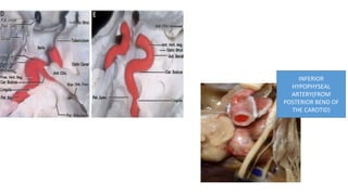 INFERIOR
HYPOPHYSEAL
ARTERY(FROM
POSTERIOR BEND OF
THE CAROTID)
 
