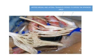 ANTERO MEDIAL AND LATERAL TRIANGLES OPENED TO EXPOSE THE SPHENOID
SINUS
 