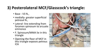 3) Posterolateral MCF/Glasscock’s triangle:
• Base - V3 N.,
• medially- greater superficial
petrosal N.,
• Lateral- line extending from
foramen spinosum to arcuate
eminence
• F. Spinosum/MMA lie in this
triangle
• Opening the floor of MCF in
this triangle exposes petrous
ICA
 