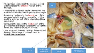 • The petrous segment of the internal carotid
artery crosses the anterior margin of this
triangle.
• The cochlea is located below the floor of the
middle fossa in the lateral apex of the triangle.
• Removing the bone in the lateral part of the
posteromedial triangle exposes the cochlea
and the anterior wall of the internal auditory
canal, and
• removing the bone in the medial part of the
posteromedial triangle exposes the side of the
clivus and the inferior petrosal sinus.
• The approach directed through the temporal
bone in this triangle is referred to as an
anterior petrosectomy
GSPN
GENICULATE
GANGLION
COCHLEA
IAC
PETROUS ICA
 