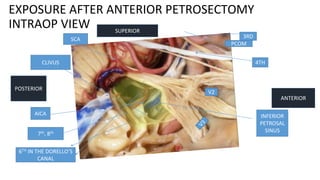 EXPOSURE AFTER ANTERIOR PETROSECTOMY
INTRAOP VIEW
ANTERIOR
POSTERIOR
SUPERIOR
CLIVUS
INFERIOR
PETROSAL
SINUS
V2
6TH IN THE DORELLO’S
CANAL
4TH
3RD
AICA
PCOM
SCA
7th, 8th
 