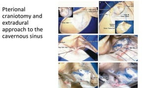 Pterional
craniotomy and
extradural
approach to the
cavernous sinus
 