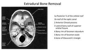 Extradural Bone Removal
1a Posterior ⅔ of the orbital roof
1b roof of the optic canal
2 Anterior Clinoid process
3 Lateral bony wall of superior
orbital fissure
4 Bony rim of foramen rotundum
5 Bony rim of foramen ovale
6 bone of Glasscock’s triangle
 