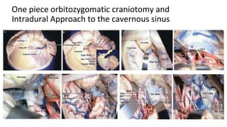 One piece orbitozygomatic craniotomy and
Intradural Approach to the cavernous sinus
 