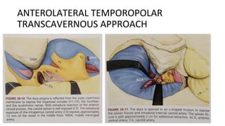 ANTEROLATERAL TEMPOROPOLAR
TRANSCAVERNOUS APPROACH
 