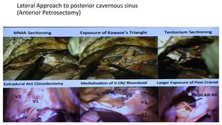 Lateral Approach to posterior cavernous sinus
(Anterior Petrosectomy)
 