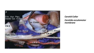 Carotid Collar
Carotido-occulomotor
membrane
 
