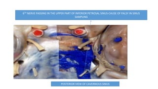 6TH NERVE PASSING IN THE UPPER PART OF INFERIOR PETROSAL SINUS-CAUSE OF PALSY IN SINUS
SAMPLING
POSTERIOR VIEW OF CAVERNOUS SINUS
 