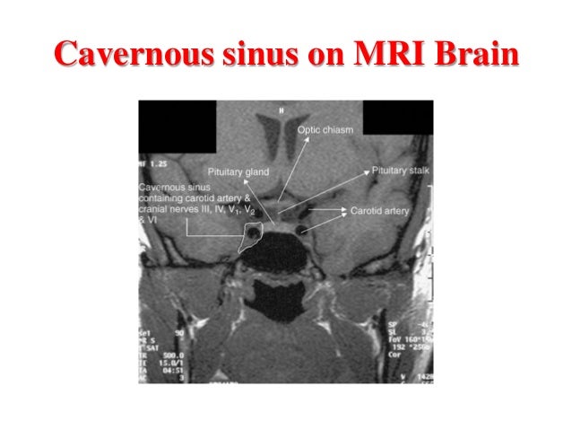 Cavernous sinus thrombosis.pdf ppt