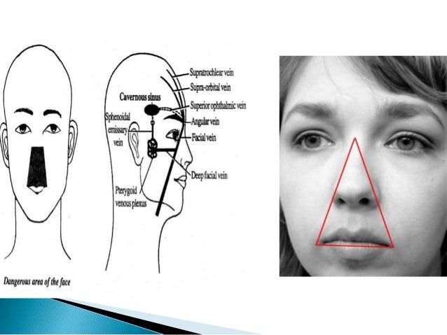 cavernous sinus thrombosis